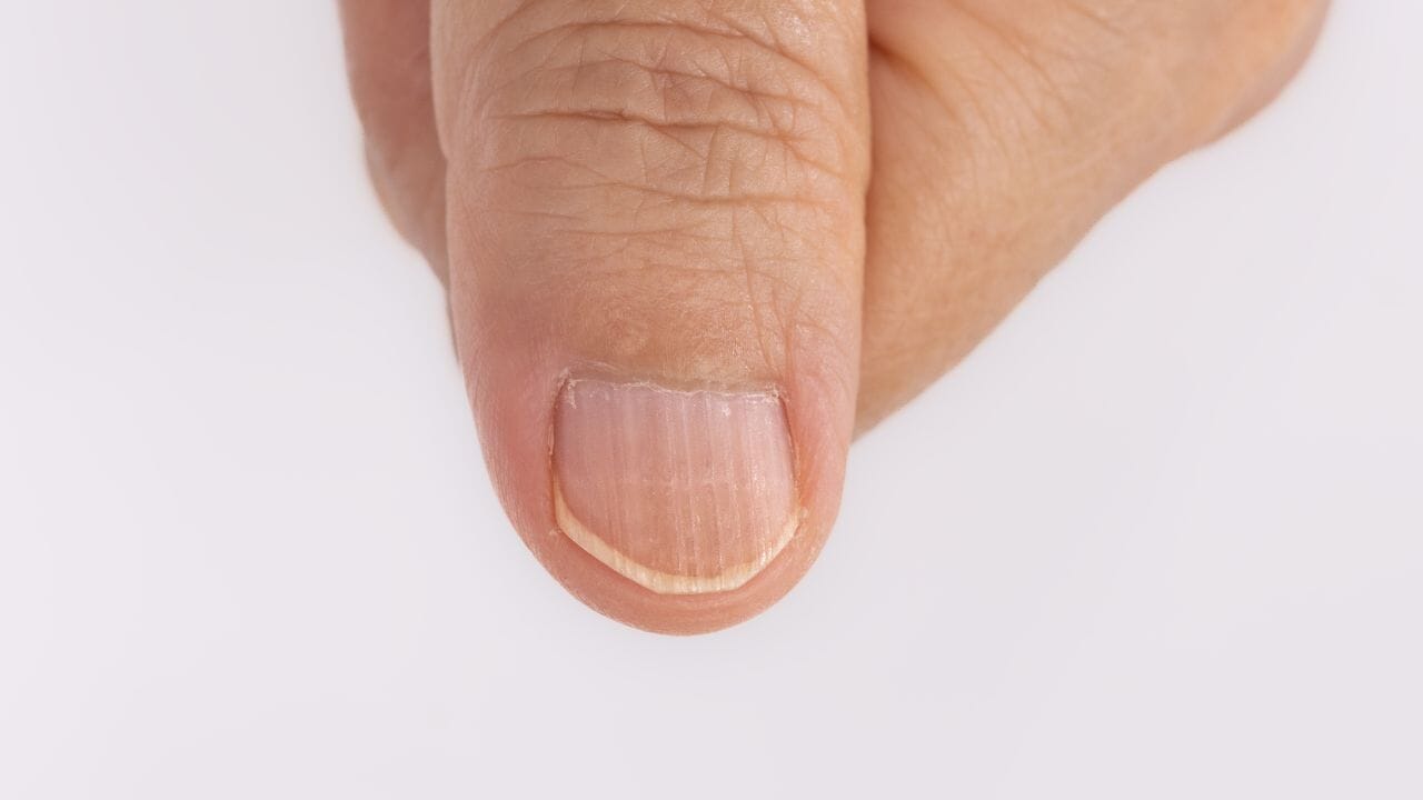 Why do my fingernails have ridges