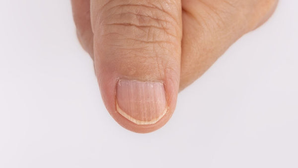 Why do my fingernails have ridges