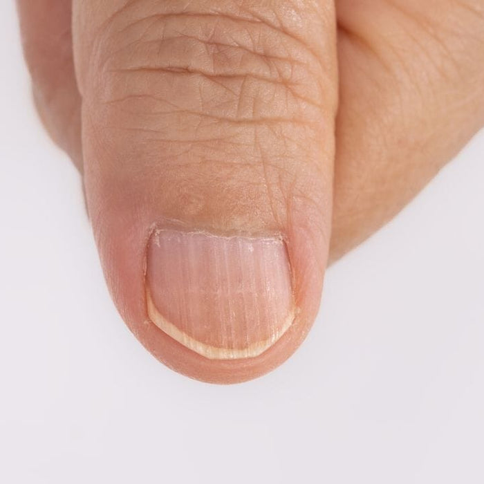 Why do my fingernails have ridges